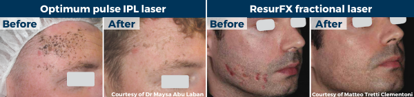 Before-after laser