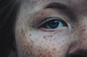 7 traits of skin cancer risk