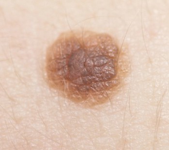 Melanoma Marchasfdg