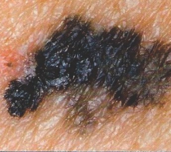 Melanoma March sad