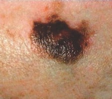 ABCDEFG melanoma guide__Al Nour (2)_page1_image11-jpg