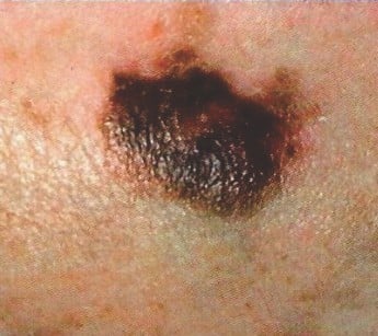 Melanoma March adsd