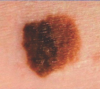 Melanoma March dsff