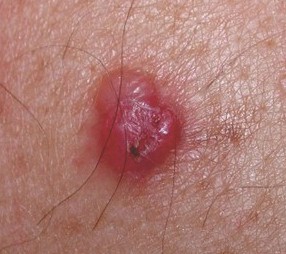 Melanoma Marchadsfd