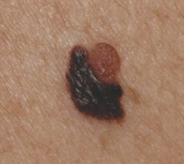 Melanoma Marchasdf