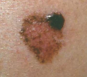 Melanoma March asdgfh