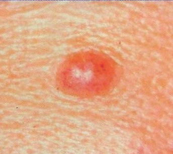 Melanoma March