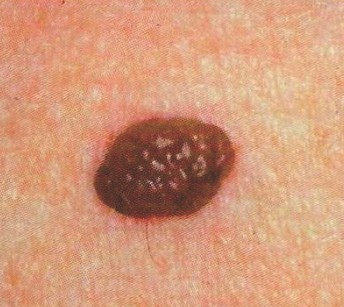 Melanoma March ads