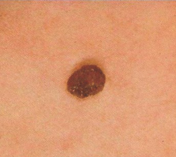 Melanoma March adsf