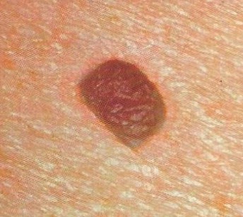Melanoma March dsfdf