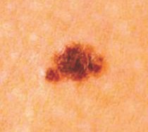 Melanoma March sfd