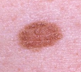 Melanoma March asfdgf