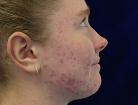Acne_before