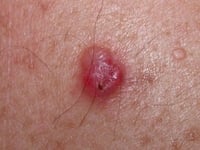 Amelanotic nodular melanoma