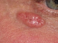 BCC nodular (1)