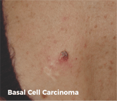 Basal Cell Carcinoma