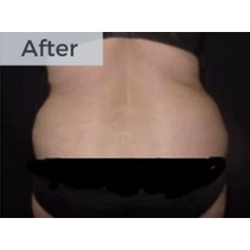 CoolSculpting After - Al Nour