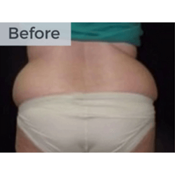 CoolSculpting before - Al Nour