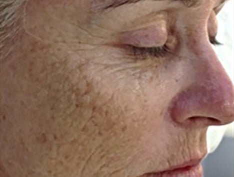 Dermapen Skin Needling__13__A