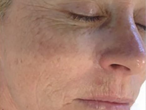 Dermapen Skin Needling__13__B