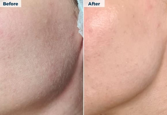 Dermaplaning B&A (1)