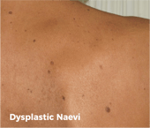 Dysplastic Naevi