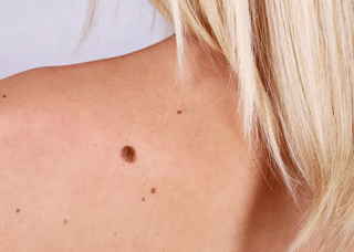 Identifying-melanoma-2