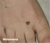 Melanoma