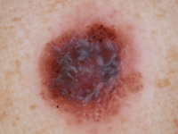 Nodular Melanoma - 2