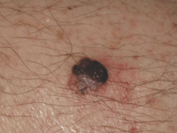 Nodular Melanoma - 1