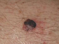 Nodular melanoma (1)-1-1