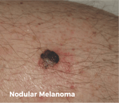 Nodular melanoma