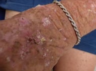 non-melanoma skin cancers D