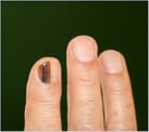 Acral melanoma
