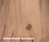 Seborrhoeic Keratosis