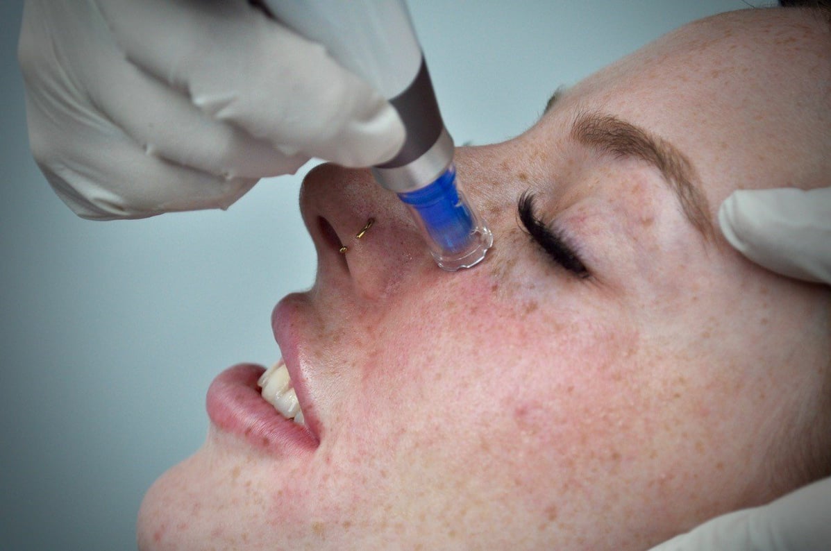 Skin Needling, close up, face-1