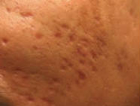 Skin Needling__1__A