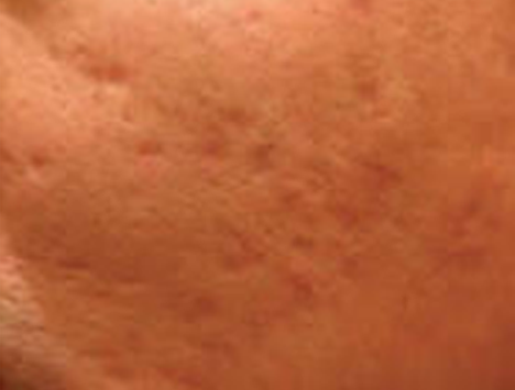 Skin Needling__1__B