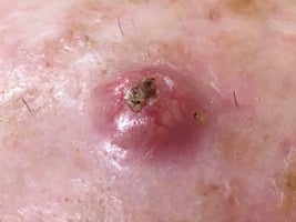 Squamous cell carcinoma SCC (1)