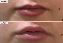 Townsville - Lip filler 2