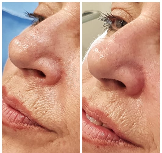 Vasculyse Treatment B&A 1