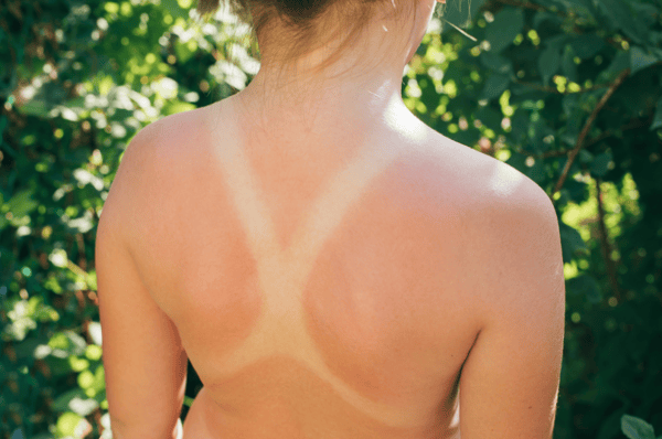 accidentally sunburnt