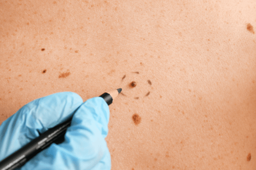 mole removal