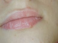 mucosal melanoma