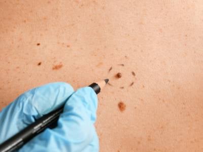 Mole removal
