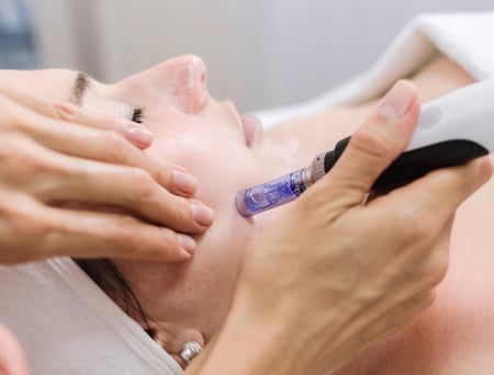 Skin needling and microdermabrasion__630x480