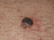 Nodular melanoma (1)-1-1