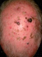 PDT B&A4X