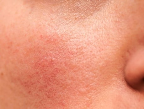 Redness & Rosacea - Concern page