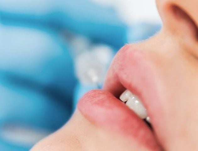 Dermal Fillers